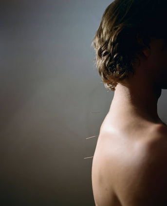 New York, Health, Acupuncture Upper East Side Treatments