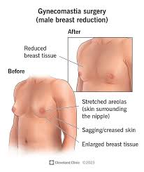 London, Medical, Male Breast Reduction London By Harley Surgical Group Experts
