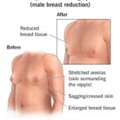 Male Breast Reduction London By Harley Surgical Group Experts