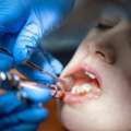 Expert Tooth Extraction In Beverly Hills | Safe & Gentle Care