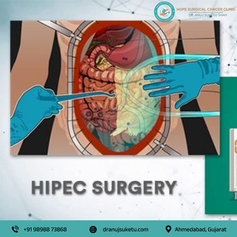 Ahmedabad, Health, Best HIPEC Treatment In Ahmedabad For Safe And Effective Cancer Surgery