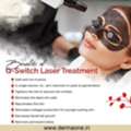 Benefits Of Q- Switch Laser Treatment - Derma One Clinic
