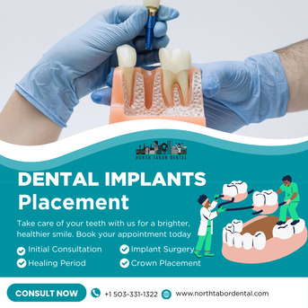 Washington DC, Health, How Safe Is Dental Implants Placement?