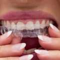 Best Invisalign Cost In Pune​