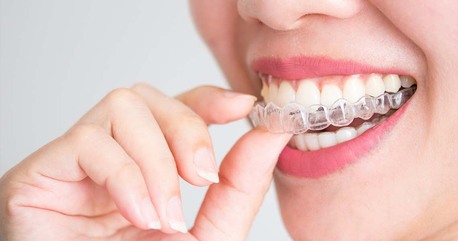 Pune, Dental, Best Invisalign Cost In Pune​