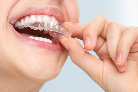 Pune, Dental, Best Invisalign Cost In Pune​