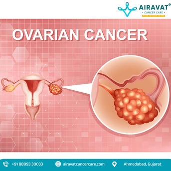 Ahmedabad, Health, Ovarian Cancer Treatment In Ahmedabad With Personalized Care