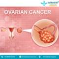 Ovarian Cancer Treatment In Ahmedabad With Personalized Care