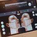 Invisible Touch: Ultherapy Uncovered