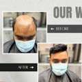 INR 8000,  Hair Patch In Kolkata | Indian Hair World