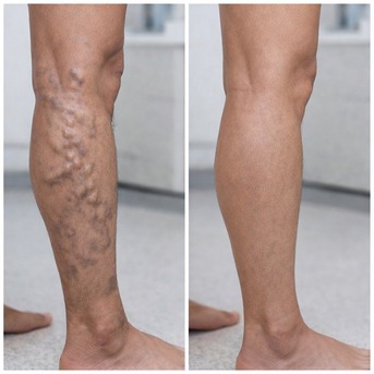 Pune, Medical, Varicose Vein Specialist In Baner - The Aesthetic Hub