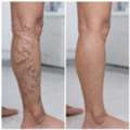 Varicose Vein Specialist In Baner - The Aesthetic Hub