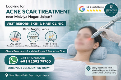 Jaipur, Health & Beauty Items, INR 2500,  Best Acne Scar Treatment Near Malviya Nagar, Jaipur