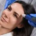 Microneedling Treatment Near Me For Radiant Skin