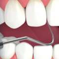 Full Mouth Reconstruction Advanced Smile Restoration At Stadium Dental & Orthodontics