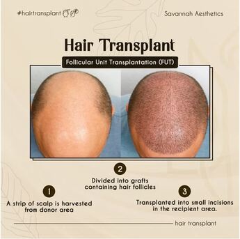 Ahmedabad, Health, Advanced Hair GFC Treatment Ahmedabad &ndash; Savannah Aesthetics