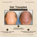 Advanced Hair GFC Treatment Ahmedabad &ndash; Savannah Aesthetics