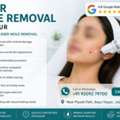 INR 2000,  Laser Mole Removal In Jaipur - Scar-Minimizing Treatment Near You