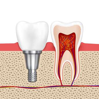 Mumbai, Dental, Dental Implants At White Dental Healthcare