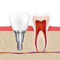 Dental Implants At White Dental Healthcare