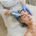 Melasma Hyperpigmentation In Mississauga