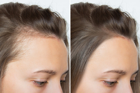 New York, Beautician, Scalp Tattoo For Thinning Hair: A Modern Solution For Fuller-Looking Confidence