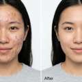 Best Acne Treatment That Actually Works In 2026