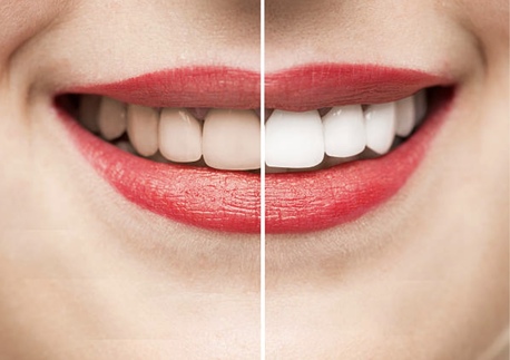 Auckland, Health, Teeth Whitening In Mount Roskill