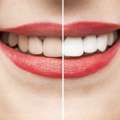 Teeth Whitening In Mount Roskill