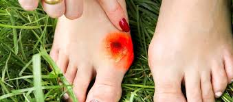 Singapore, Health, Radiant Heels: 5 Foot Bunion Treatment