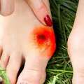 Radiant Heels: 5 Foot Bunion Treatment