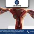 Trusted Uterine Fibroids Treatment Doctor In India - Dr.Dharav Kheradia
