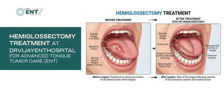 Jaipur, Health, Hemiglossectomy Treatment At Drvijayenthospital For Advanced Tongue Tumor Care