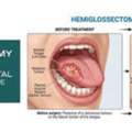 Hemiglossectomy Treatment At Drvijayenthospital For Advanced Tongue Tumor Care
