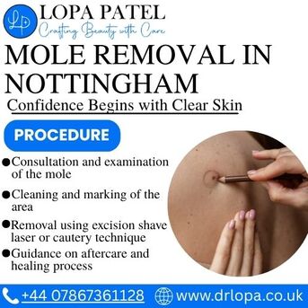 London, Health, Mole Removal In Nottingham