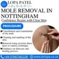 Mole Removal In Nottingham