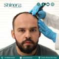 Shinora Clinic - Advanced Technology For Hair Transplant In Ahmedabad