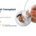 Best Hair Transplant Surgeon In Delhi For Safe And Natural Results