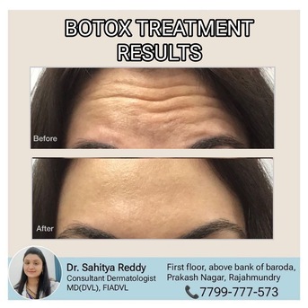 Kurnool, Health, Botox Results At Dermacure Clinic - Rajahmundry
