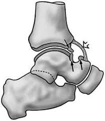 Singapore, Health, Rising Above: Your Guide To Ankle Ligament Surgery Recovery