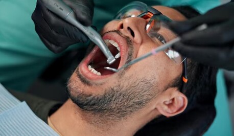 Cape Town, Dental, Safe & Gentle Tooth Extraction In Beverly Hills