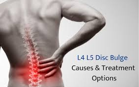 Gurgaon, Businesses For Sale, Advanced Disc Bulge Treatment In India &ndash; Effective Spine Care & Pain Relief Solutions