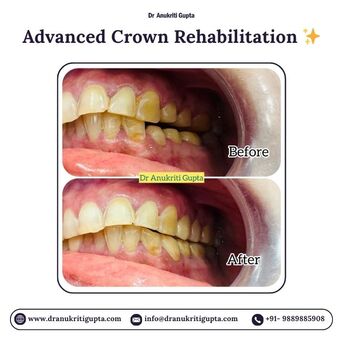 Gurgaon, Dental, Advanced Crown Rehabilitation In Gurgaon | Dr. Anukriti Gupta Gurgaon