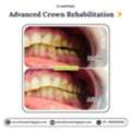 Advanced Crown Rehabilitation In Gurgaon | Dr. Anukriti Gupta Gurgaon