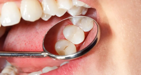 Perth, Dental, Learn About Dental Fillings From The Top Cosmetic Dentist Australia