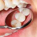 Learn About Dental Fillings From The Top Cosmetic Dentist Australia