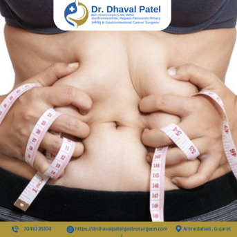 Ahmedabad, Health, Leading Bariatric & Metabolic Surgery In Ahmedabad By Dr. Dhaval Patel