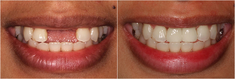 New York, Dental, Implant Dentistry For Permanent Tooth Replacement - Dublin Metro Dental