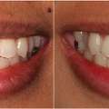 Implant Dentistry For Permanent Tooth Replacement - Dublin Metro Dental