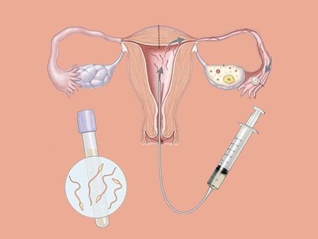 New Delhi, Health, Best IUI Clinic In Kalkaji South Delhi For Fertility Care